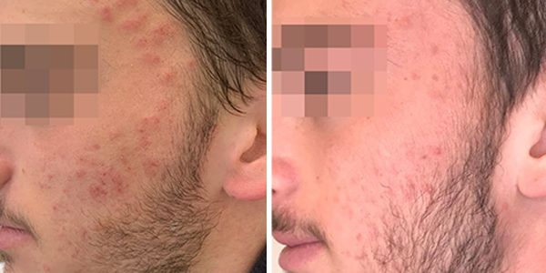 Acne treatment