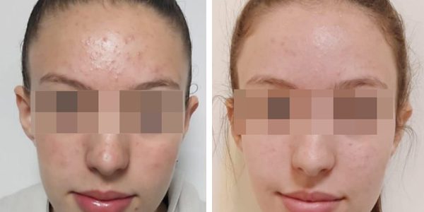 Acne & oily treatment
