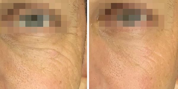 Anti-aging treatment
