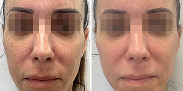 Pigmentation treatment