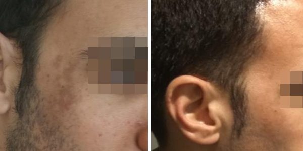Hyper-pigmentation treatment