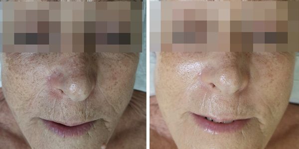 Rejuvenation treatment