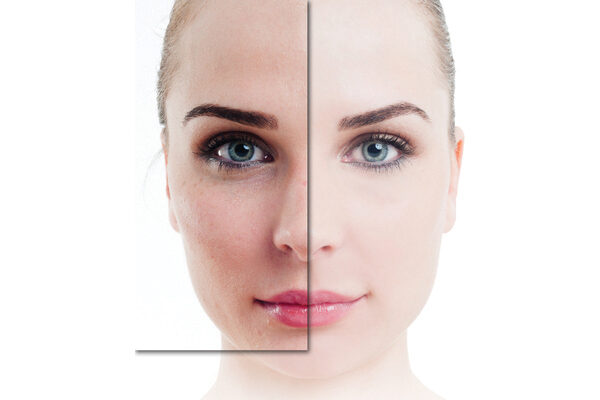 Skin Lightening Treatments