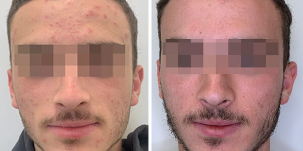 Comprehensive acne treatment