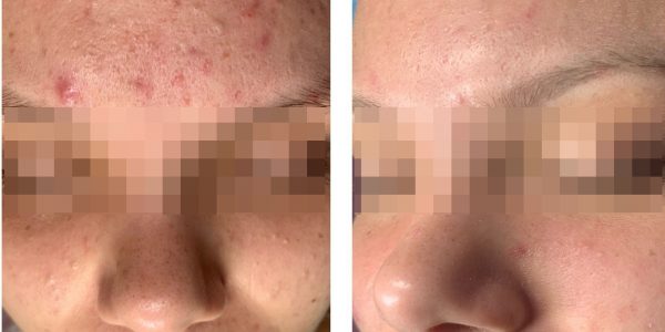 Acne treatment