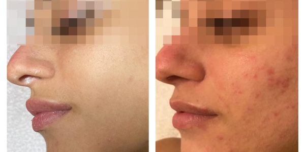 acne tretment
