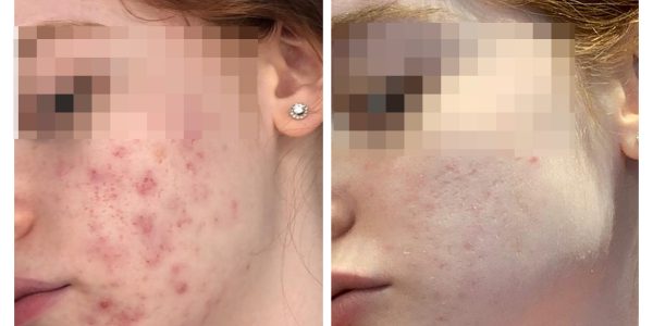 acne tretment