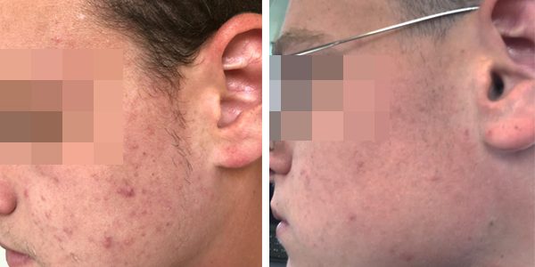 Rejuvenation treatment
