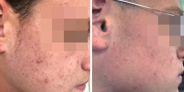 Acne treatment